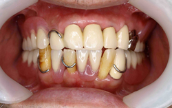 歯周病、歯周外科、予防処置、口臭