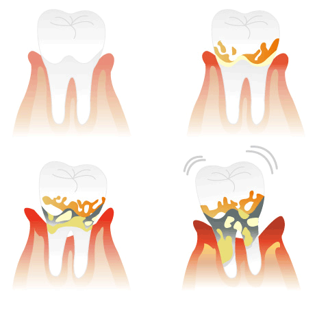 歯周病、歯周外科、予防処置、口臭