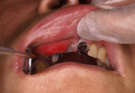 歯性感染症（細菌感染）